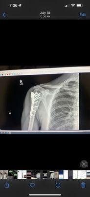 My shoulder destroyed by Dr Doan Nguyen