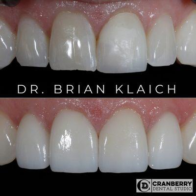 A closeup view of 4 porcelain veneers and crowns by Dr. Brian