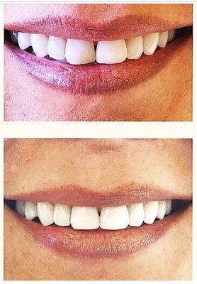 Before and after. Subtle changes can make a difference. Replaced discolored resin fillings to create a brighter and straighter smile line.