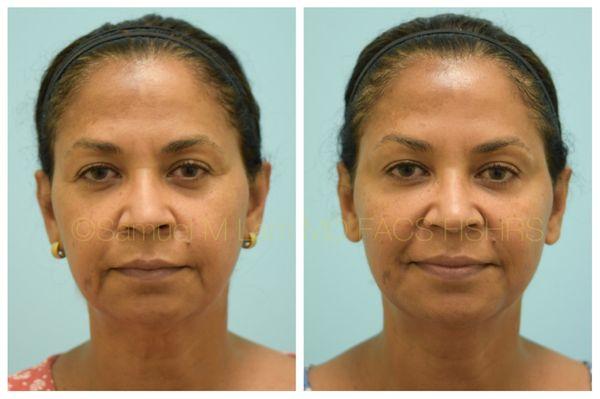 This 54-year-old female is shown before and two weeks after Botox and fillers with Dr. Lam.