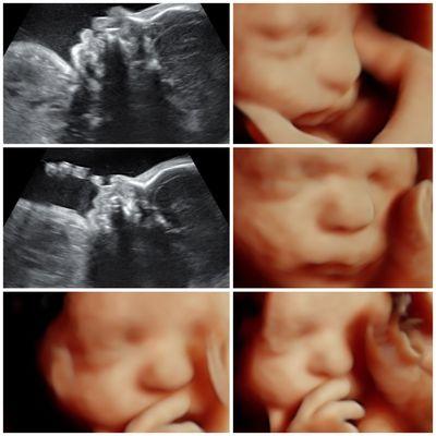 Baby Bound Ultrasound