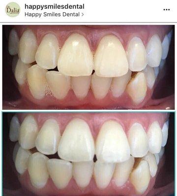 Before and after our basic teeth whitening. Research shows that your smile is your most noticed feature; let us professionally brighten it.