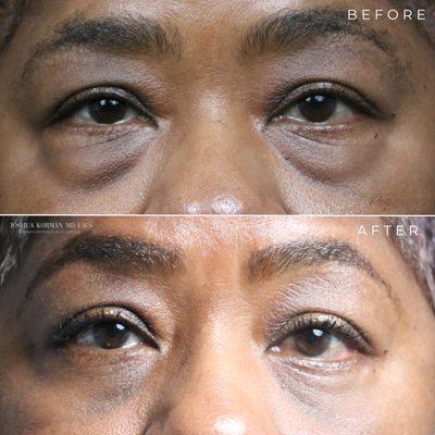 Upper & Lower Blepharoplasty