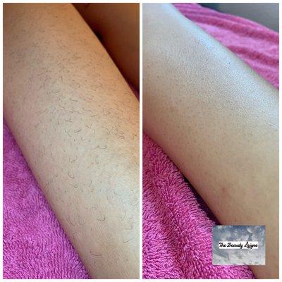 Before and after Sugaring Hair Removal