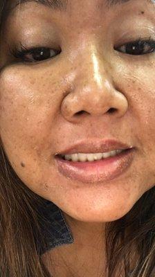 She has a lot of sun spots, hyper-pigmentation & freckles. After deep cleansing a Medium depth Peel was done to reduce & rid sun damage.