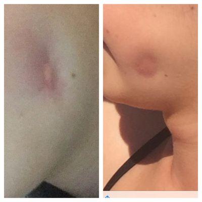 The progression of the infection (month 3 and 4).