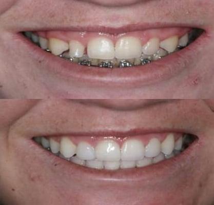 Our Before/after pics- Six Units of IPS Emax Veneers