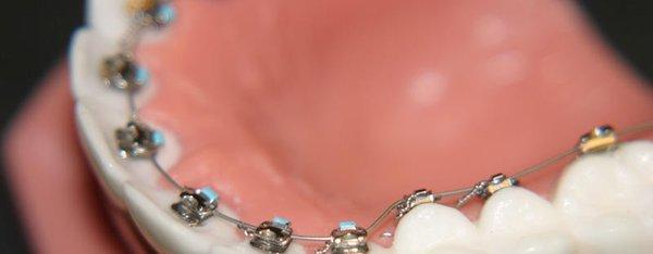 Dental Bridges