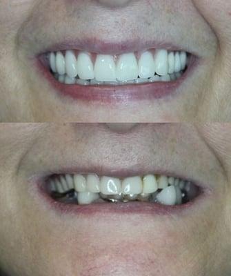 Full mouth rehabilitation and total life make over with brand new beautiful smile.  Stunning results = happy patients! - Dr. Lentz