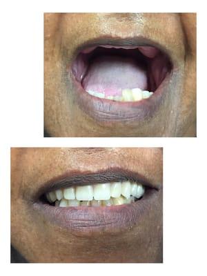 Before and After photo of a denture patient