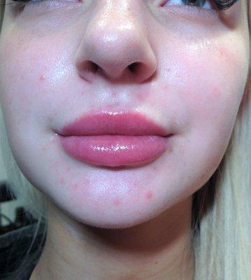 Lip filler results