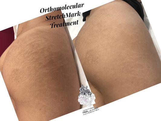 Stretchmark Treatment Before and After 
 2nd Visit