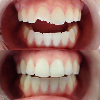 Before and after of teeth reconstruction