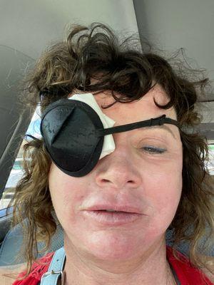 Couldn't drive for six weeks after my surgery by Dr Fezza because I had such severe double vision