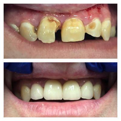 Patient came in unhappy with their smile due to cavities.  Here we opted to  crown her front teeth and give the patient their smile back.