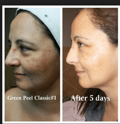 www.greenpeel.com Best Facial on the Market