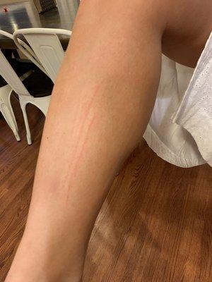 Scratches from pedicure