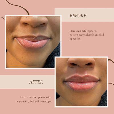 Lip filler before and after