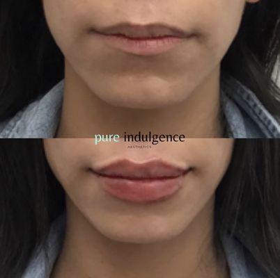 Before and After | Non-surgical Lip Augmentation