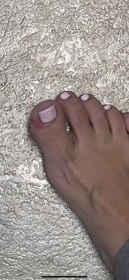 Ingrown toenail/infection