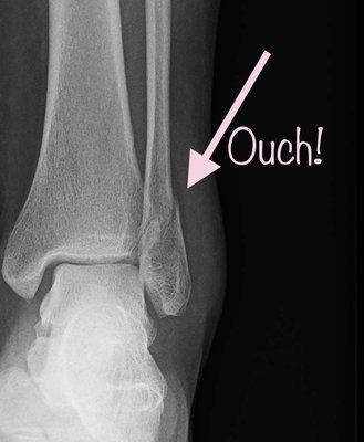 My mildly displaced lateral malleolus fracture! Yayyyy (*sarcasm) lol