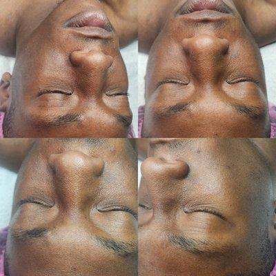 Pigment Correct Peel Treatment