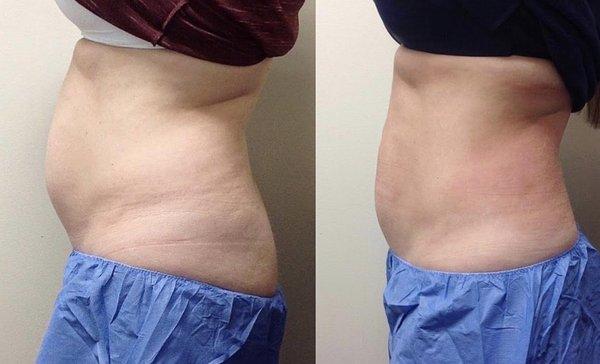 CoolSculpting before and after