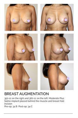 Breast Augmentation