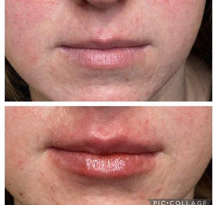 Lip fillers