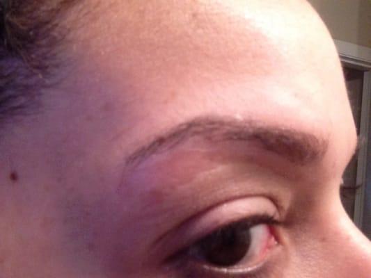 Right eyebrow w all my skin torn off...