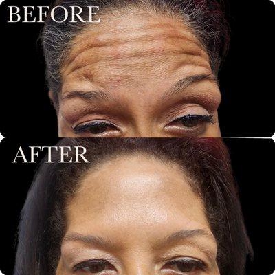 Smooth foreheads make people happy with the help of Botox