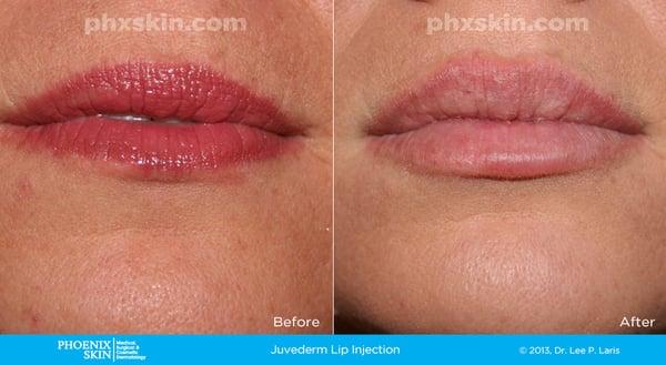 Juvederm, a dermal filler, injection to add volume to the lips