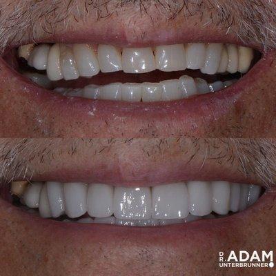 This is a full mouth reconstruction with crowns on upper and lower teeth that Dr. Adam Unterbrunner completed.  Another great result.