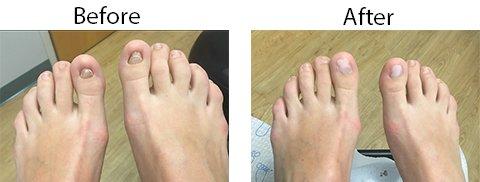 Cosmetic Nail Reconstruction