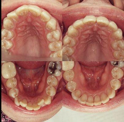 Invisalign treatment to straighten teeth.