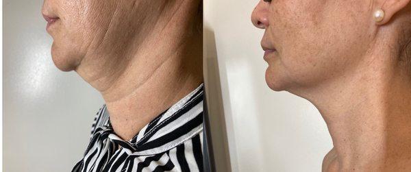 Neck Tightening Treatment Folsom CA