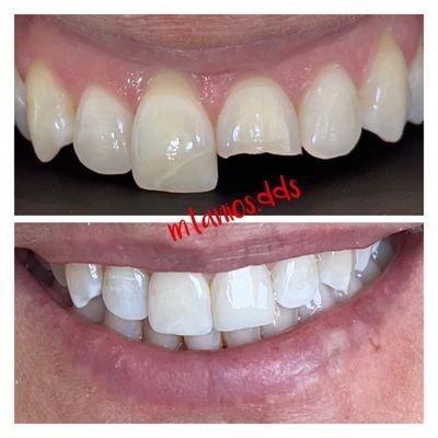 Before and after in just 30 minute; building up the fractured tooth back up! Love making our patients smile again!