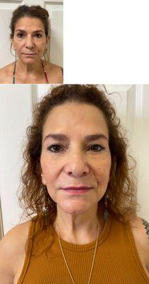 Before and after Sculptra.