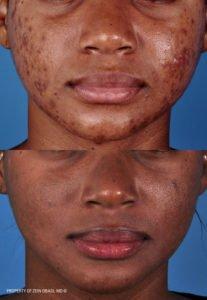 Reduce Acne Scars