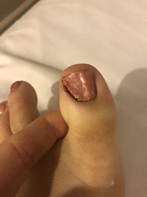 The bloody toe (with a horrible polish job) a couple days later, still swollen, inflamed, and bleeding on and off.