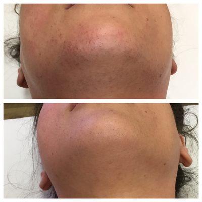 Before and after 1 laser hair removal session