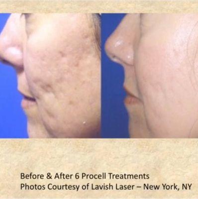 Collagen induction therapy and stem cell treatment reduce acne scarring and skin texture