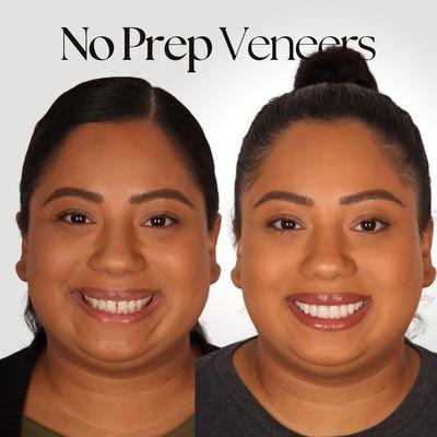 10 No Prep Veneers