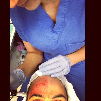 Microneedling Procedure with Hyaluronic Acid Serum