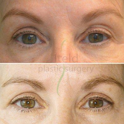 Blepharoplasty (upper eye lids) - before and after