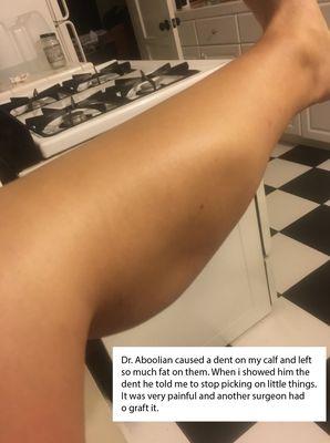 Dr Andre Aboolian caused indentations on my calves and pretended nothing was wrong