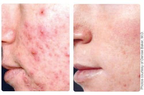 Acne Treatment Before & After