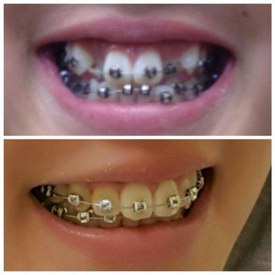 Braces by Dr Thanh-Duc Nguyen, 2017