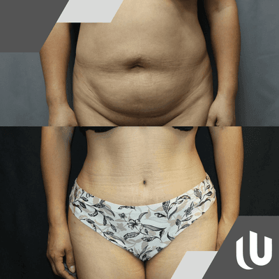 United Plastic Surgery | Tummy Tuck