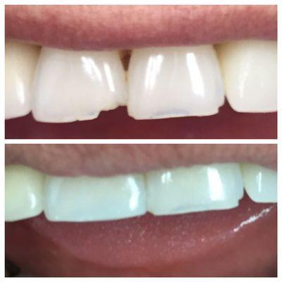 Bonding to fix chipped tooth in the left